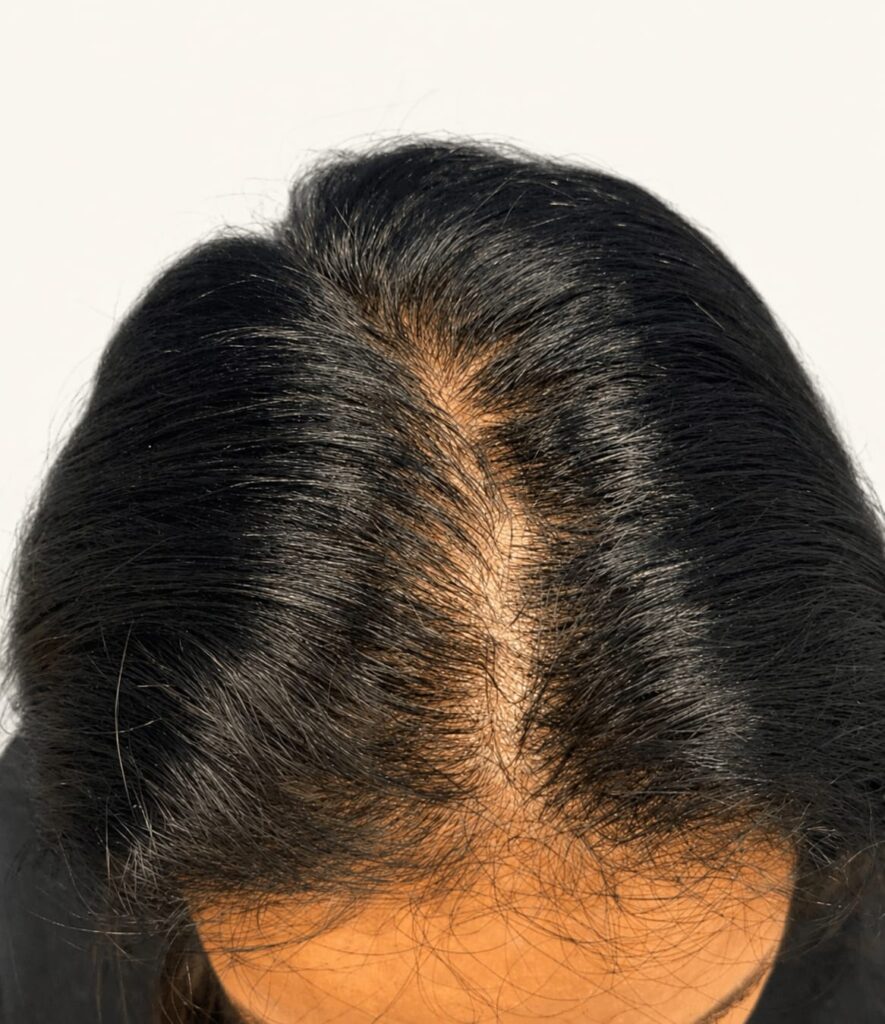 After hair restoration