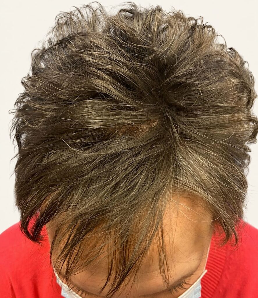 After hair restoration