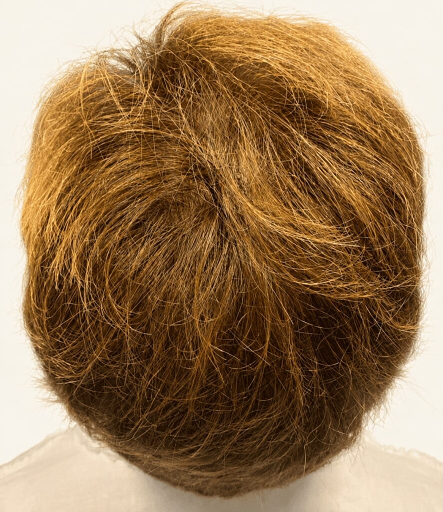 After hair restoration