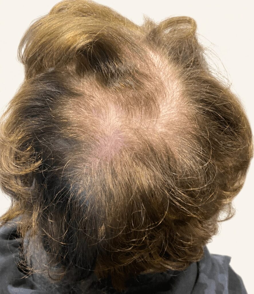 Before hair restoration