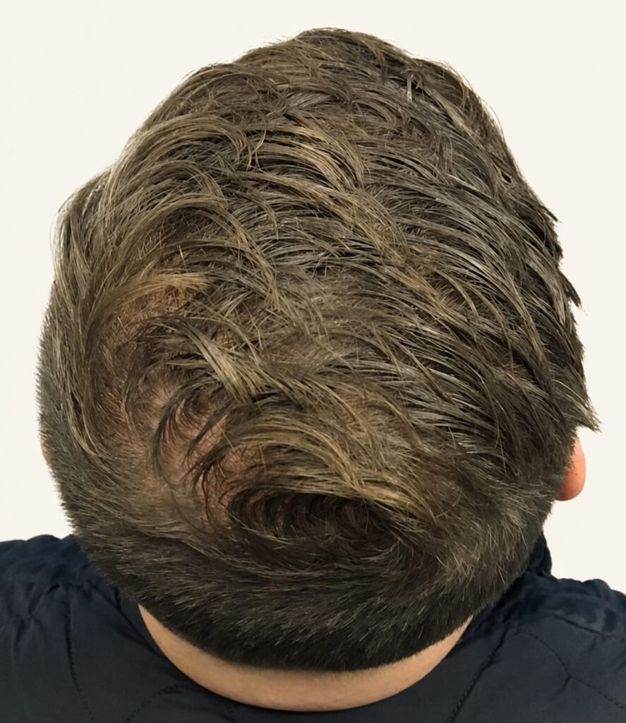 After hair restoration