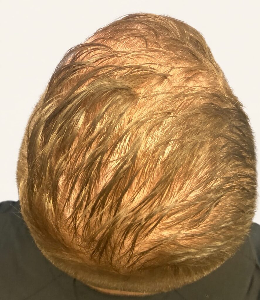 Before hair restoration