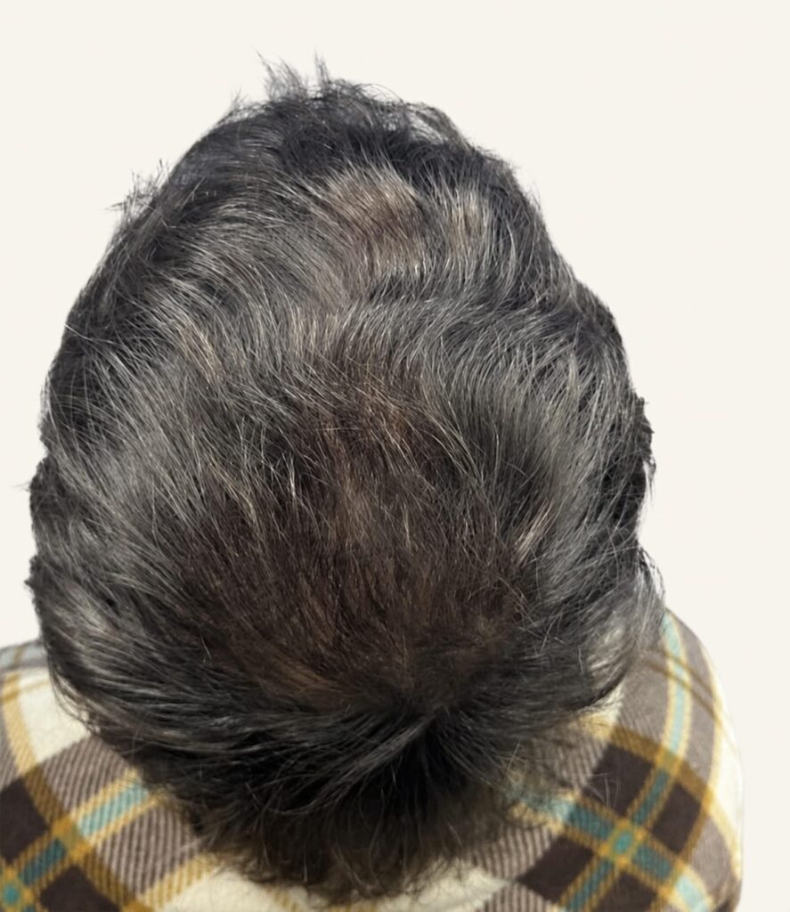 After hair restoration
