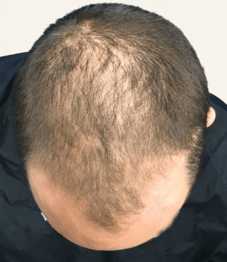 Before hair restoration