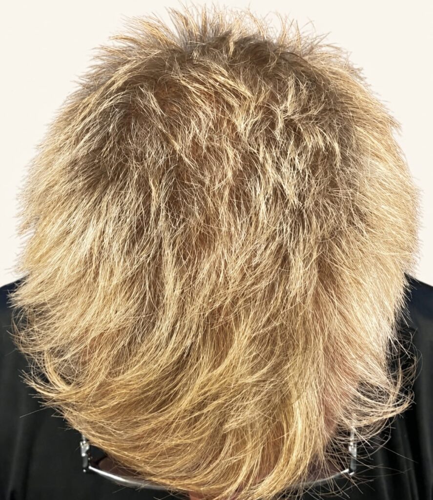 After hair restoration
