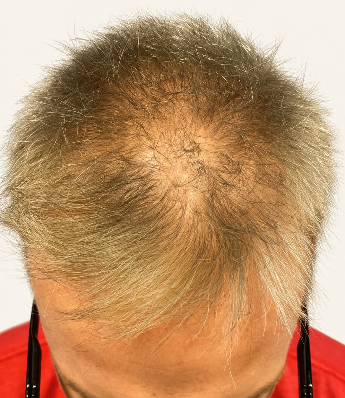 Before hair restoration