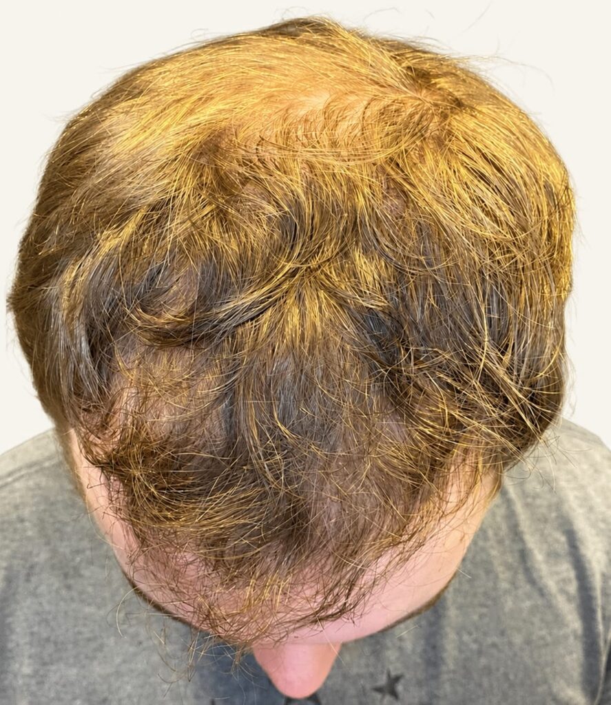 After hair restoration