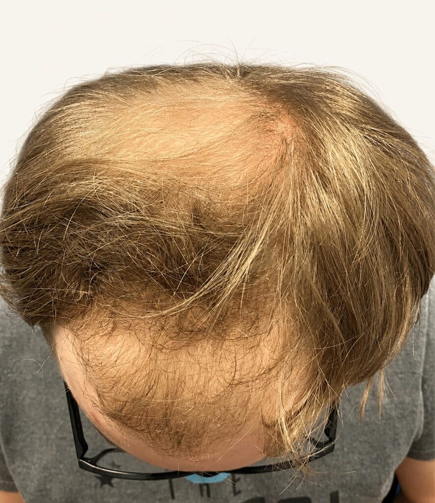 Before hair restoration