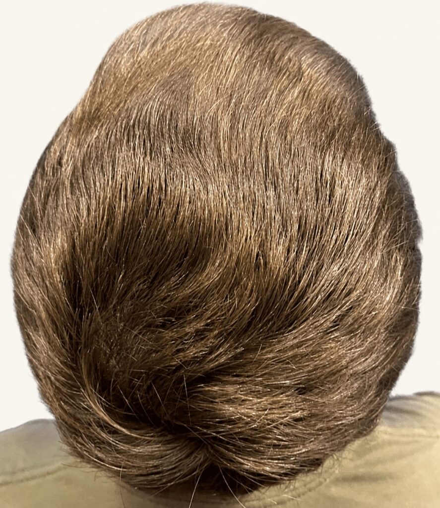 After hair restoration