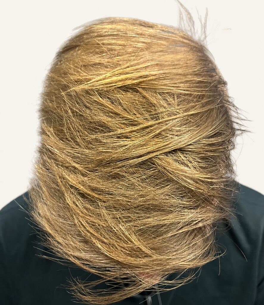 After hair restoration