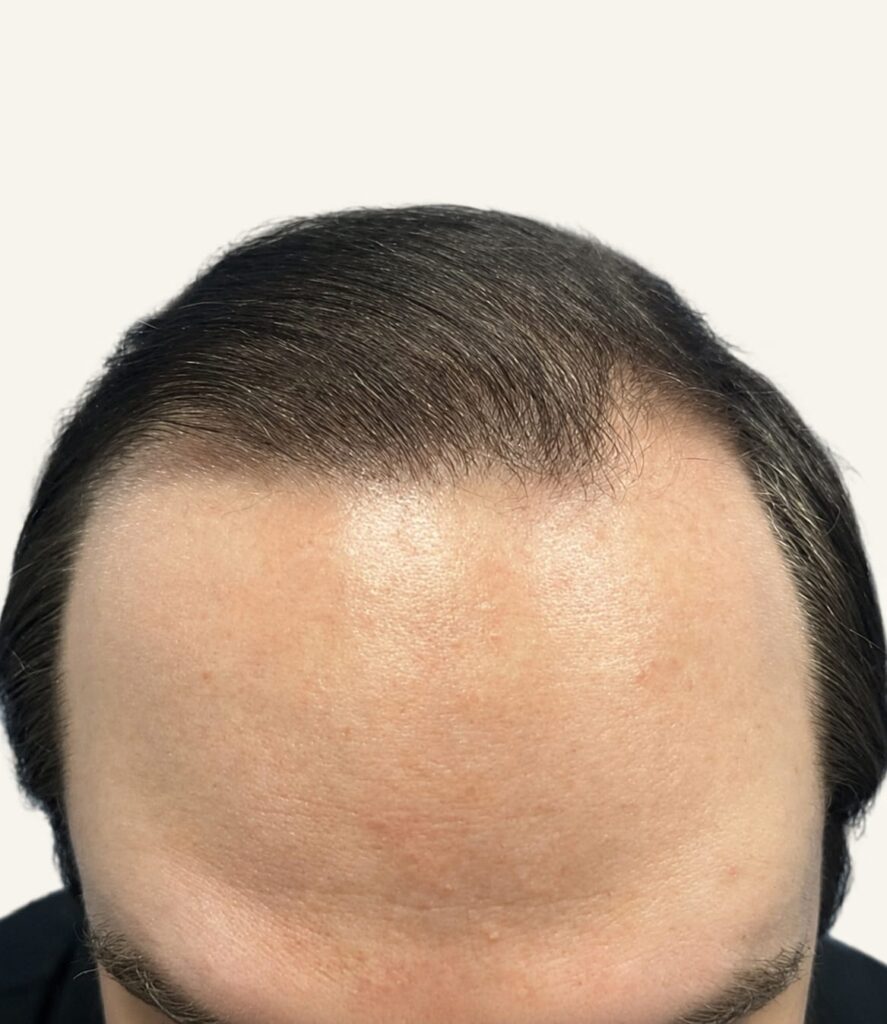 After hair restoration