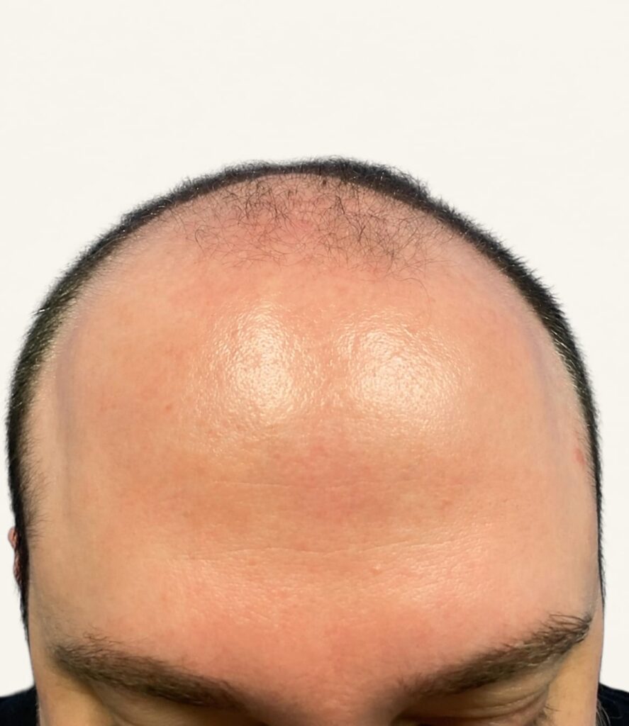 Before hair restoration