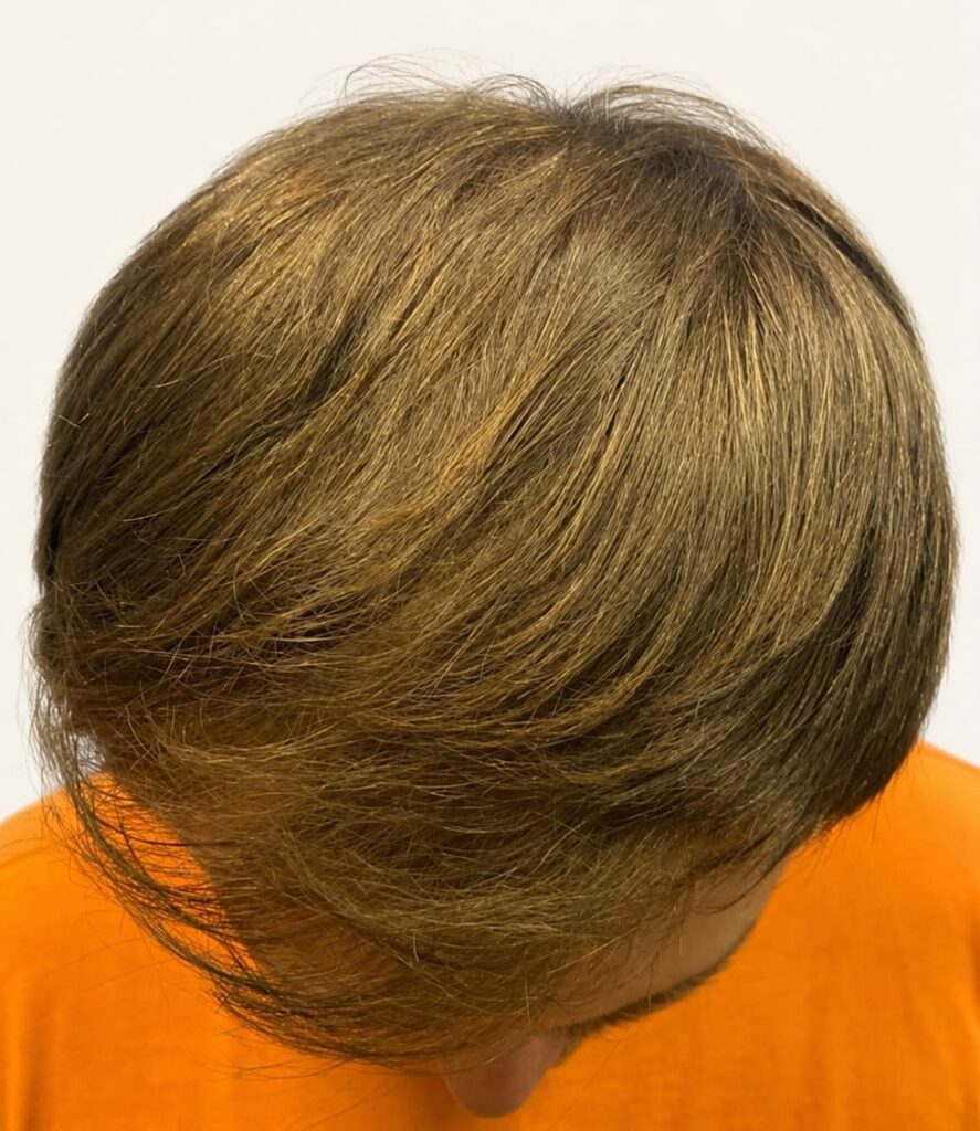 After hair restoration