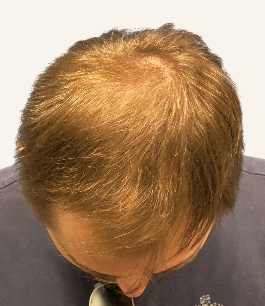 Before hair restoration