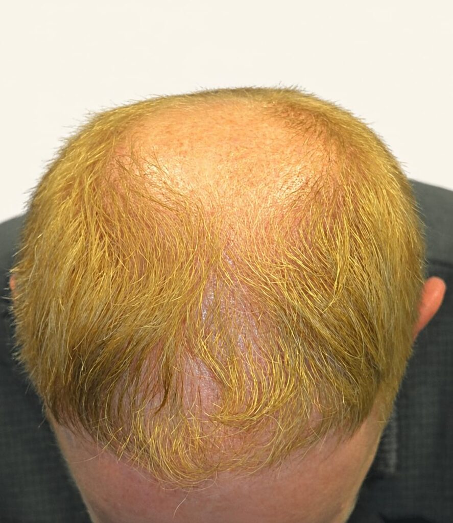 Before hair restoration