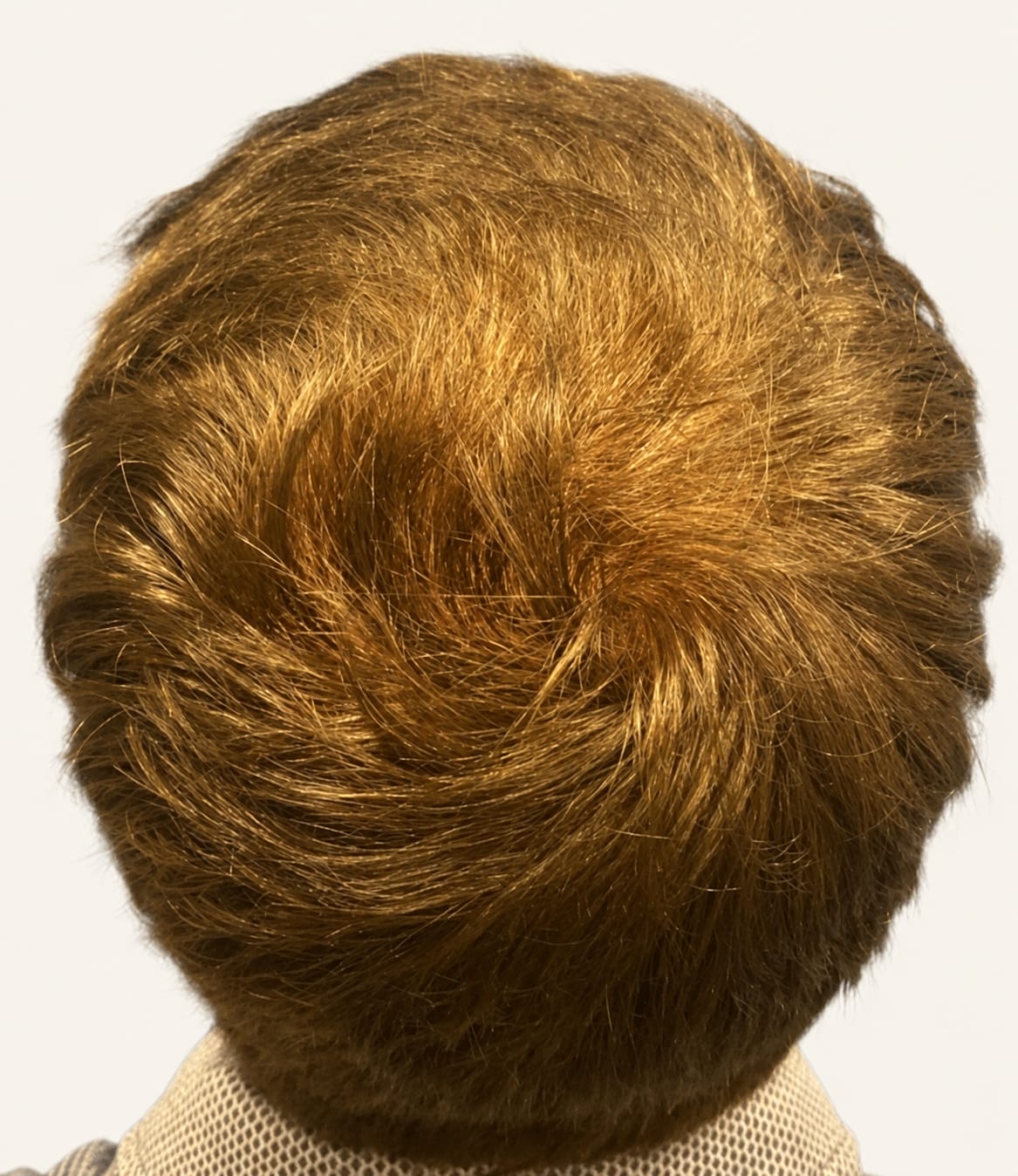 After hair restoration
