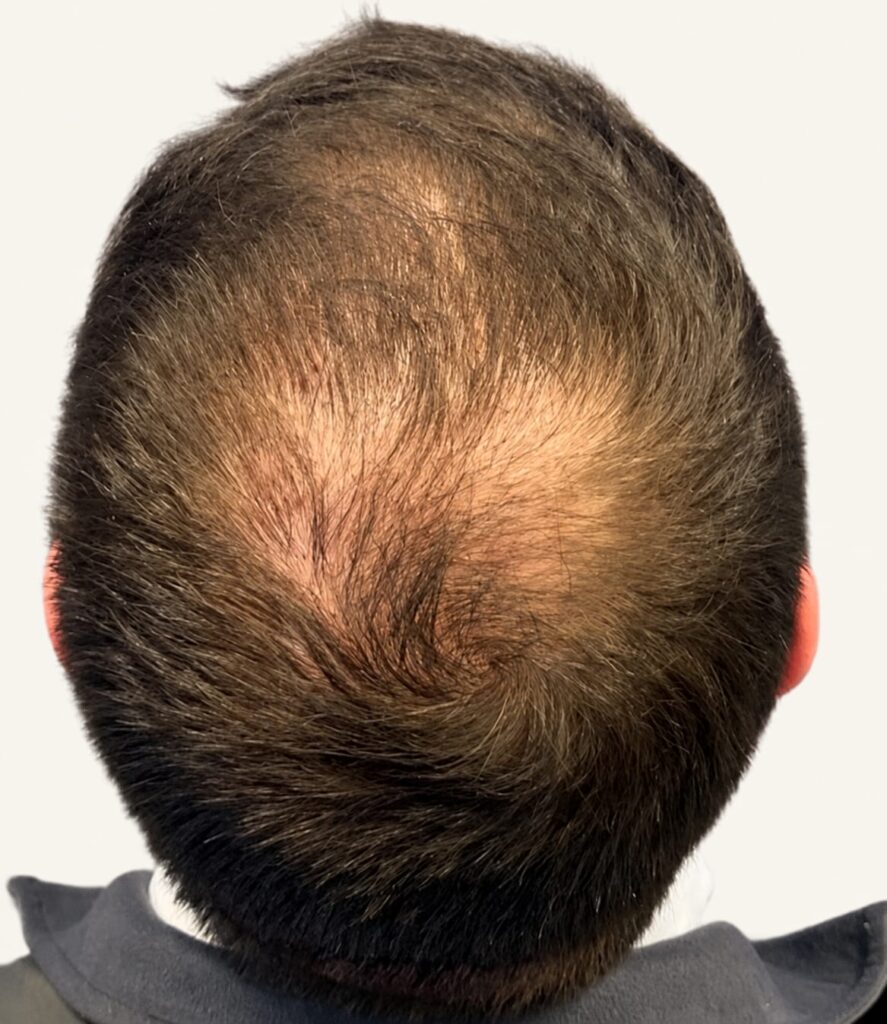 Before hair restoration