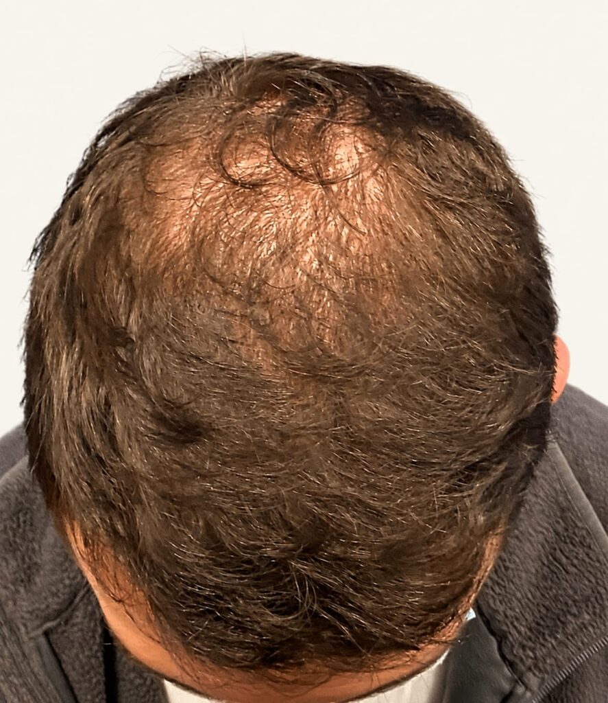 Before hair restoration