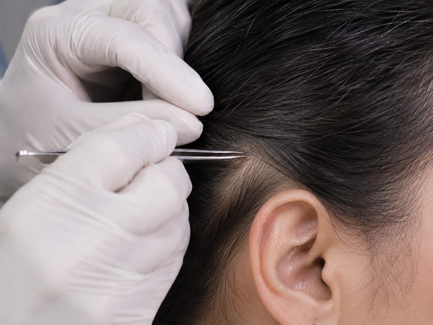 Gloved hands parting fine hair above a patient's ear to select donor follicles for eyebrow restoration