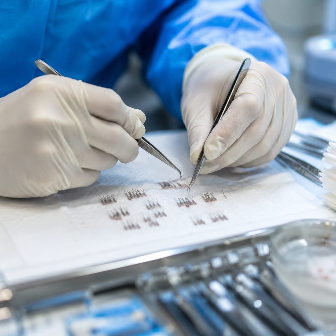 Gloved surgical hands preparing follicular unit grafts with fine forceps in a hair transplant suite