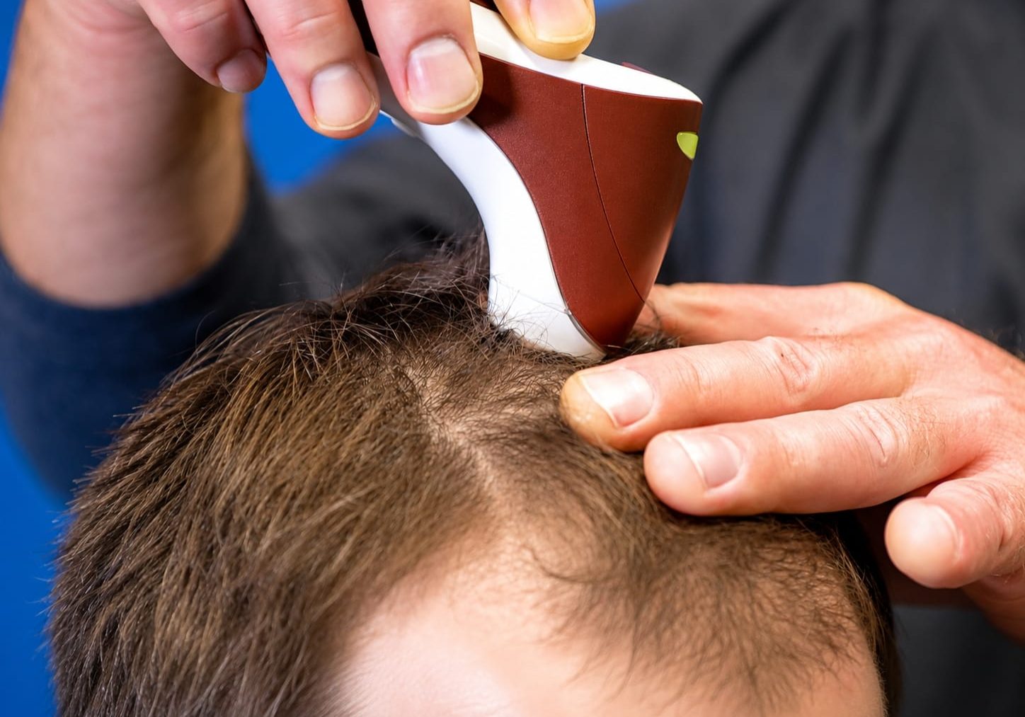 Handheld scalp camera held against a man's thinning crown to check hair density